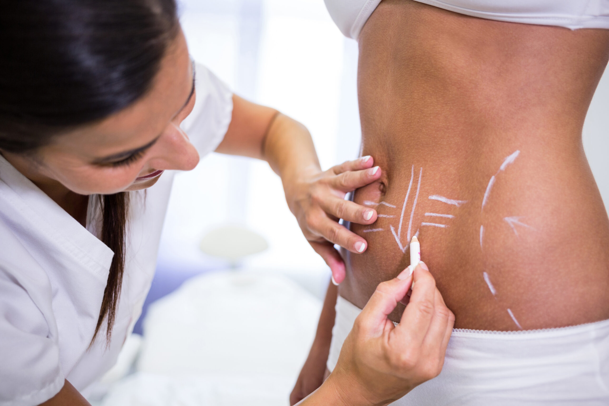 Practitioner marking a woman’s abdomen for fat reduction treatment, representing comparison between non-surgical body sculpting and surgical liposuction.